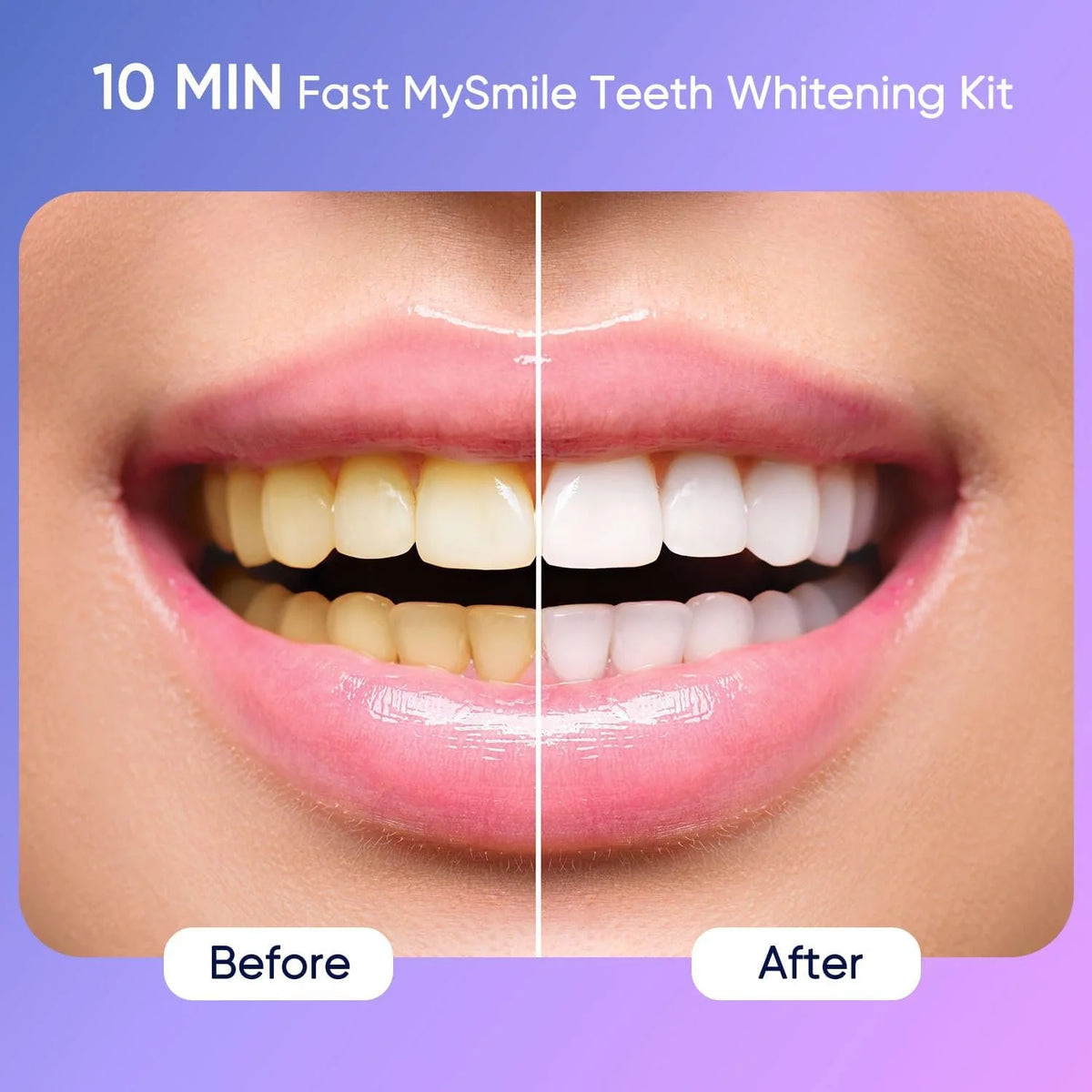 Ultimate Teeth Whitening Kit with 28 LED Light, 4X 3ML 35%CP Teeth Whitening Gel, 1X 4ML Teeth Whitening Pen, 10 Min, Remove 10 Years of Stains